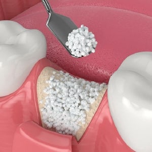 Bone Grafting