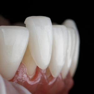 Dental Veneers