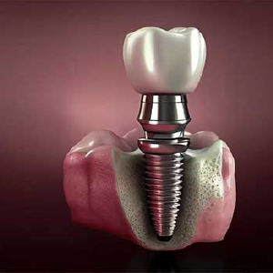Dental Implants