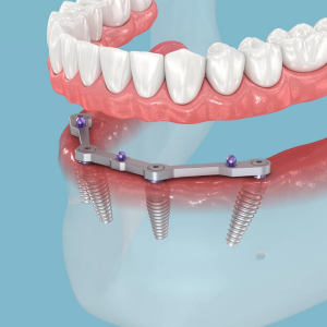 All-on-6 Implants