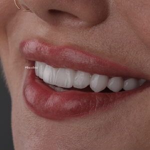 Голливудская улыбка