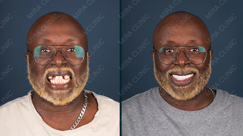 before after hollywood smile 