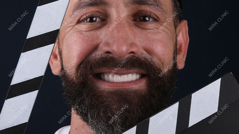 Hollywood smile Pain-Free Experience