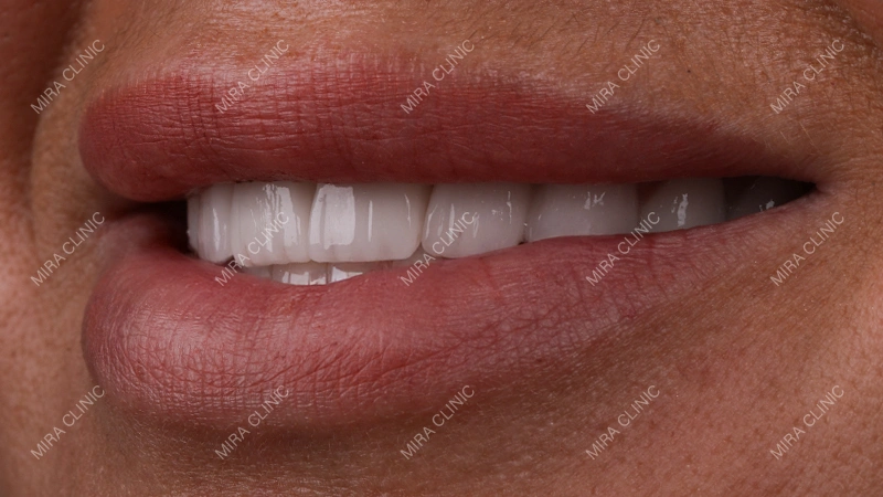 Hollywood smile Mira clinic
