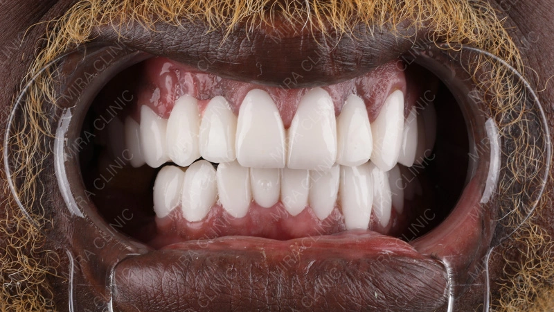 Patient Experience Missing teeth