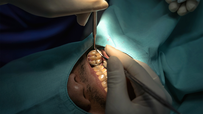 Implant Placement Surgery