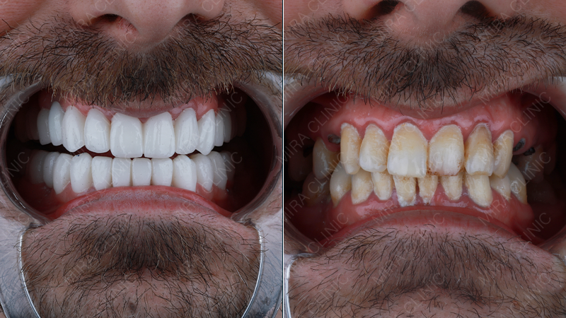 Hollywood smile real patient review