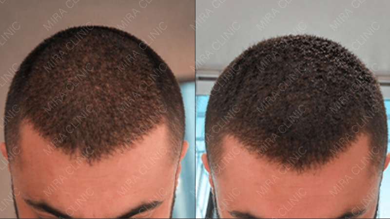 Healing  and the Waiting Phase