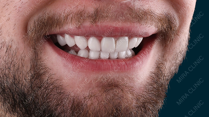 Hollywood smile after