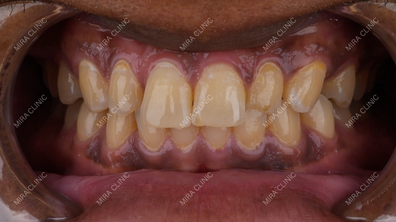 Before Veneers