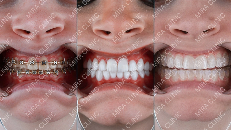 Veneers vs Braces vs Invisalign