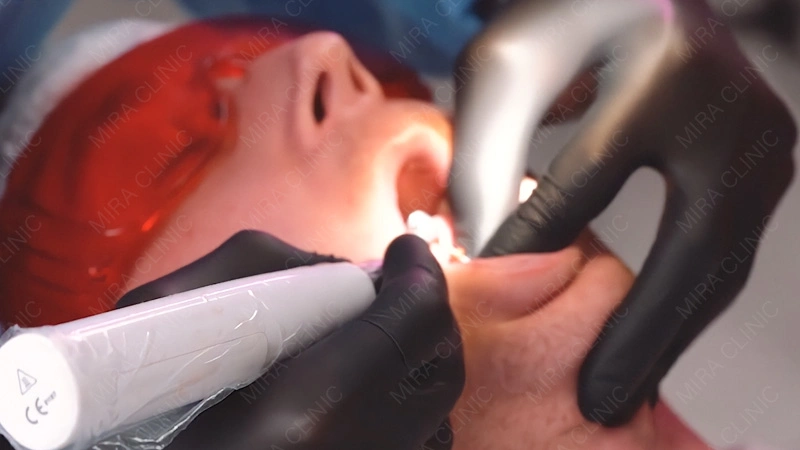 Hollywood smile prearation