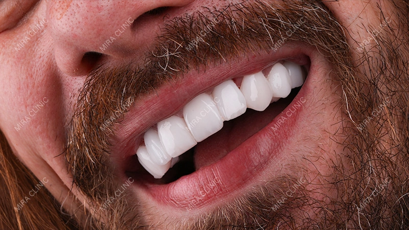 smile makeover result