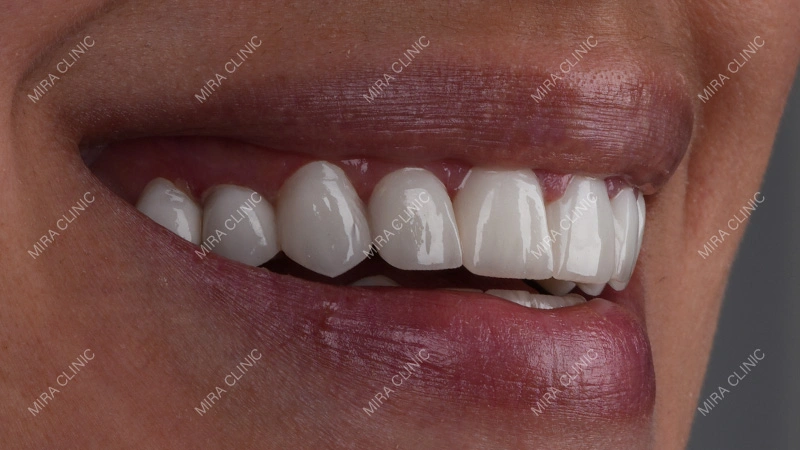 Veneer