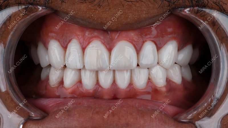 Veneers