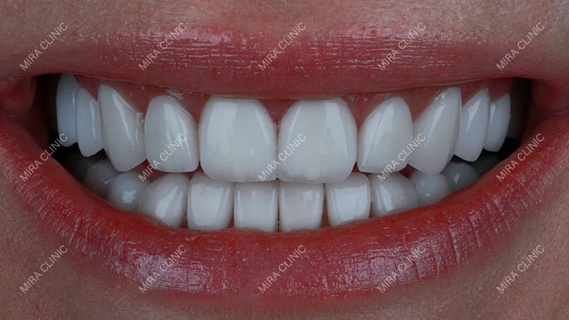 Veneers