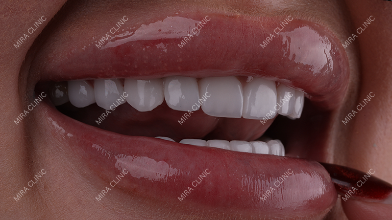 Veneers 