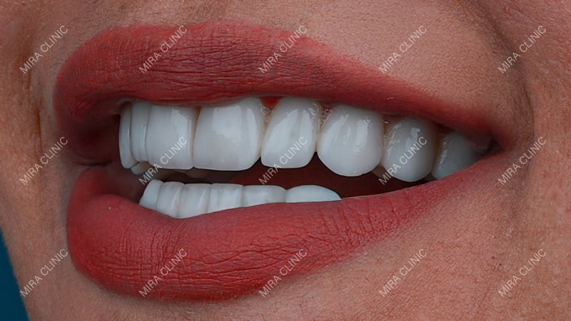 Zirconia crowns
