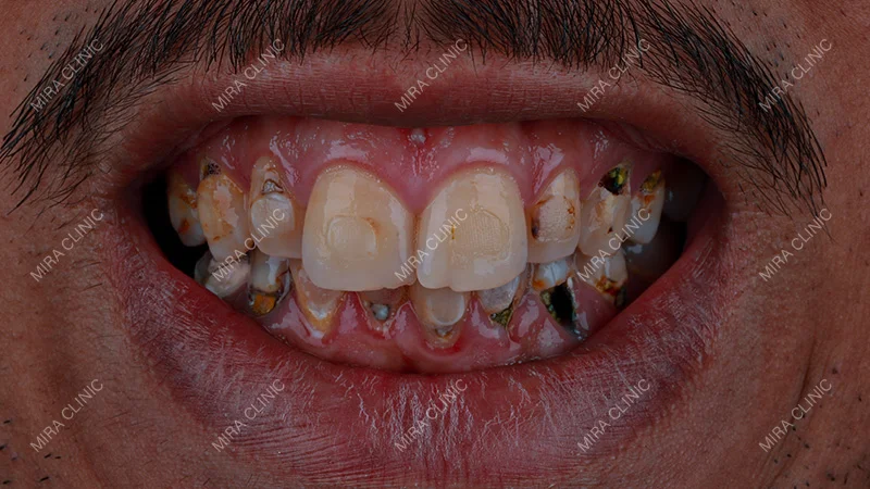 Damaged Front Teeth and Loss of Confidence