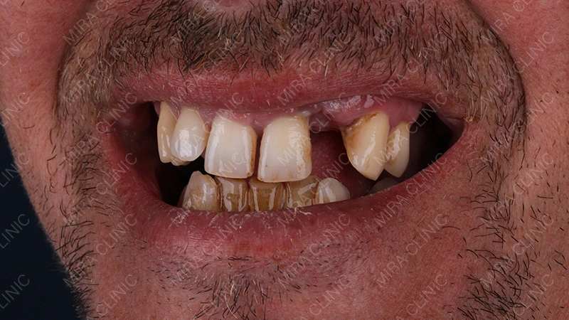 periodontitis