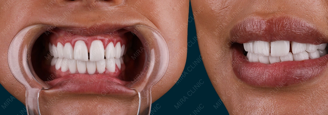 Pourquoi certaines facettes paraissent fausses, grandes ou épaisses en Turquie ? Qu’est-ce qui provoque réellement des résultats peu naturels