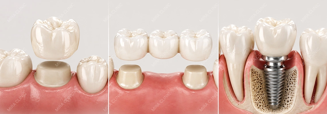 Crown, Bridge or Implant: Which Dental Treatment Is Best in Turkey?
