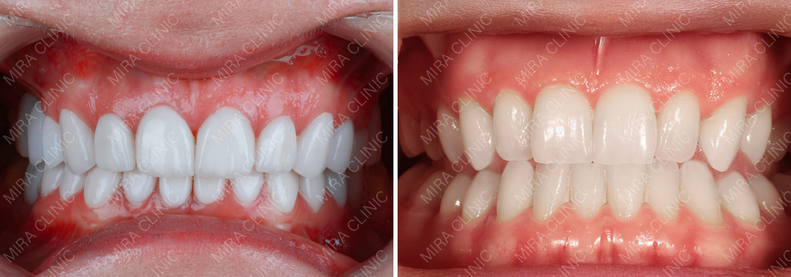 القشور أم تبييض الأسنان للتصبغات؟ أيهما يعطي نتيجة أفضل، ومتى يفشل التبييض؟ (دليل تركيا 2026)