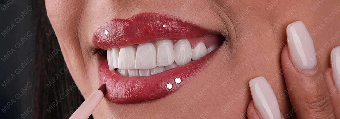 Hollywood Smile Aftercare: The Professional 10-Year Maintenance Protocol