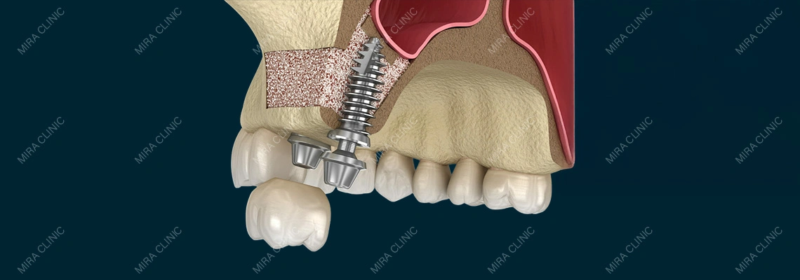 Procédure de Sinus Lift Interne: Pourquoi Elle Est Réalisée et à Quoi les Patients Doivent S'attendre