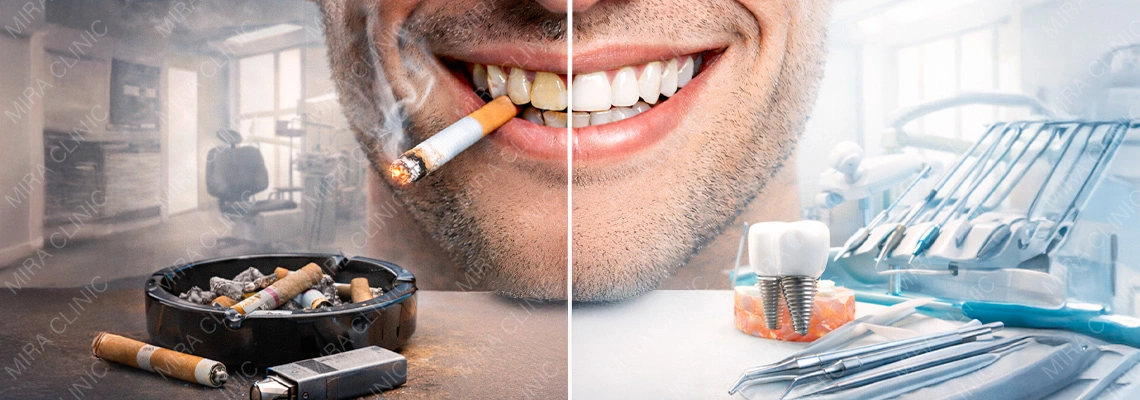 ابتسامة هوليوود للمدخنين في تركيا: هل يمكنك الحفاظ على ابتسامة مشرقة؟