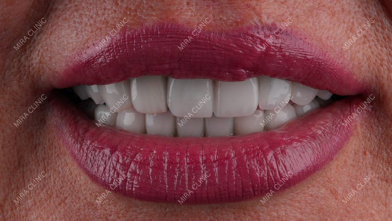 Hollywood Smile in Turkey: All-Inclusive Packages, Prices & Lifetime Warranty (2027)