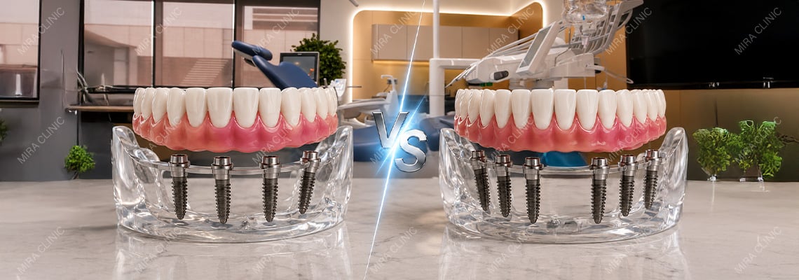 All-on-4 vs All-on-6 Cost: When Do Two Extra Implants Provide Better Value?