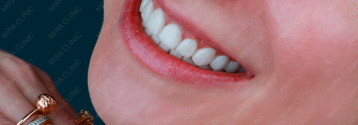 Сколько служат виниры в Турции: срок службы, уход и необходимость замены