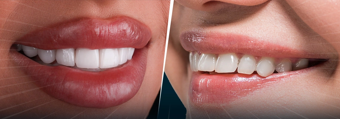 Разница между Smile Makeover и Hollywood Smile в турции в 2026 году