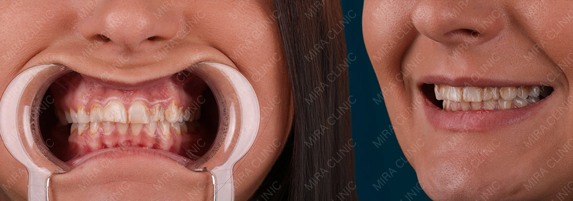 The Gummy Smile Solution: Combining Laser Gum Contouring with Veneers