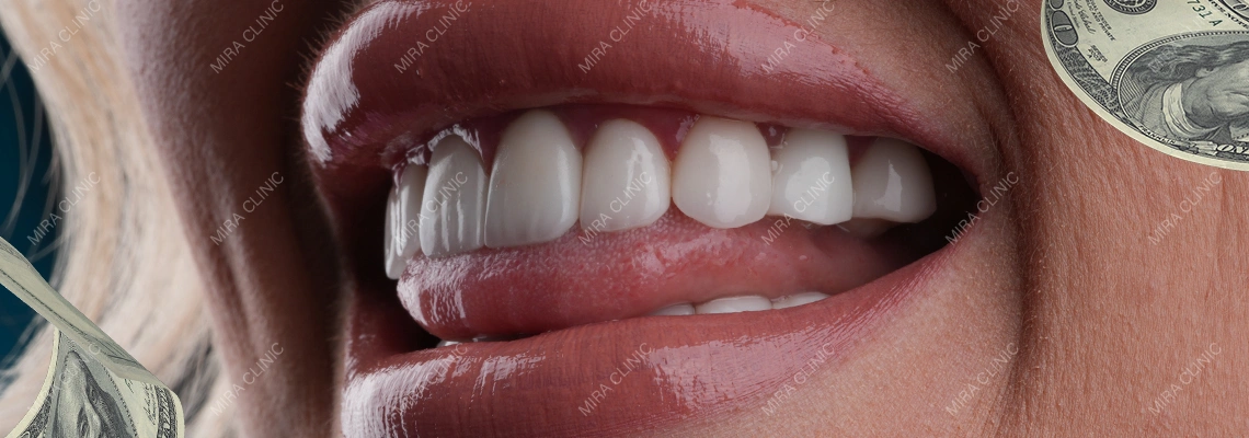 Veneers Cost in Turkey: Full Set Prices, Packages, and Smile Makeover Options