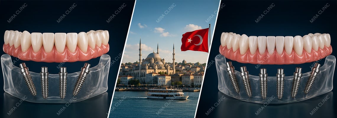 All-on-4 Dental Implants Turkey Cost vs All-on-6: Prices and Candidate Needs