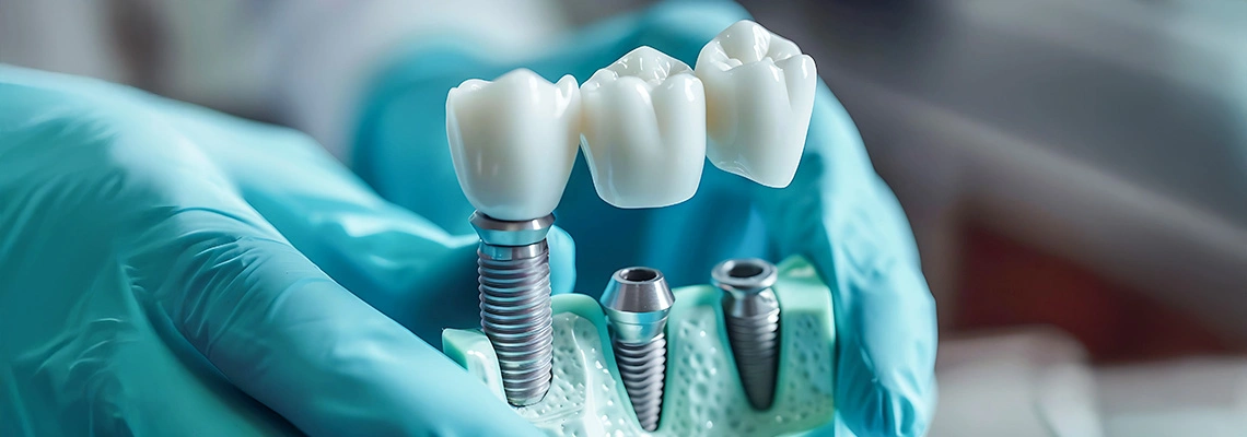 Best Dental Implant Brands in the World (2026 Guide)