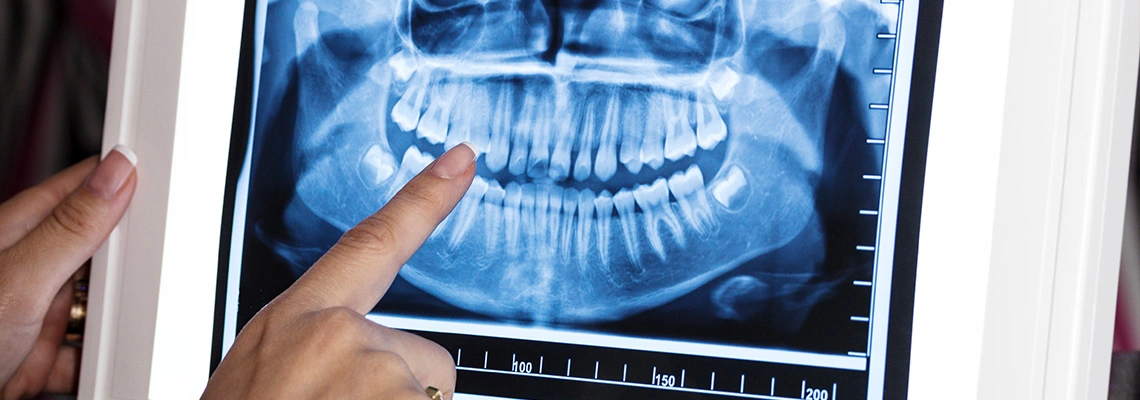 تصميم الابتسامة الرقمي (DSD) في تركيا: معاينة ابتسامتك الجديدة قبل العلاج