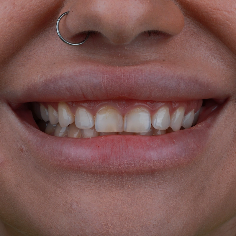 Голливудская улыбка в Турции – Стоимость, Пакеты услуг и Процедура (руководство 2026 года)