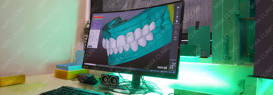 Digital Smile Design (DSD) en Turquie 2026 : comment les dentistes planifient un Hollywood Smile avant toute facette, couronne ou remodelage gingival