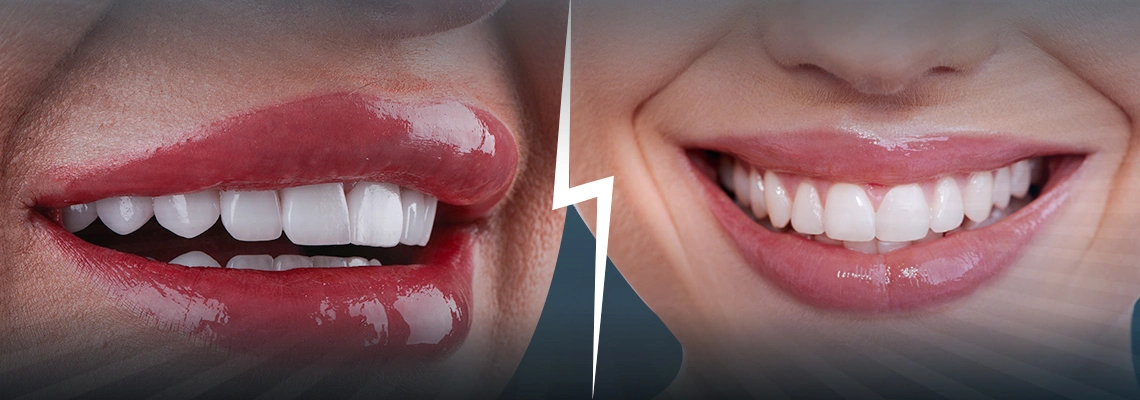 Hollywood Smile vs. Blanchiment des Dents en Turquie : Comparaison des Coûts, des Résultats et de la Durabilité