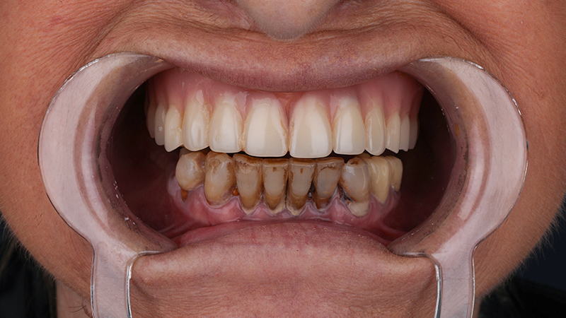 Hollywood Smile Makeover in Turkey (2026) | Everything You Need to Know