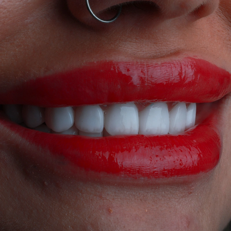 ابتسامة هوليوود في تركيا – التكلفة، الباقات والإجراءات (دليل 2026)