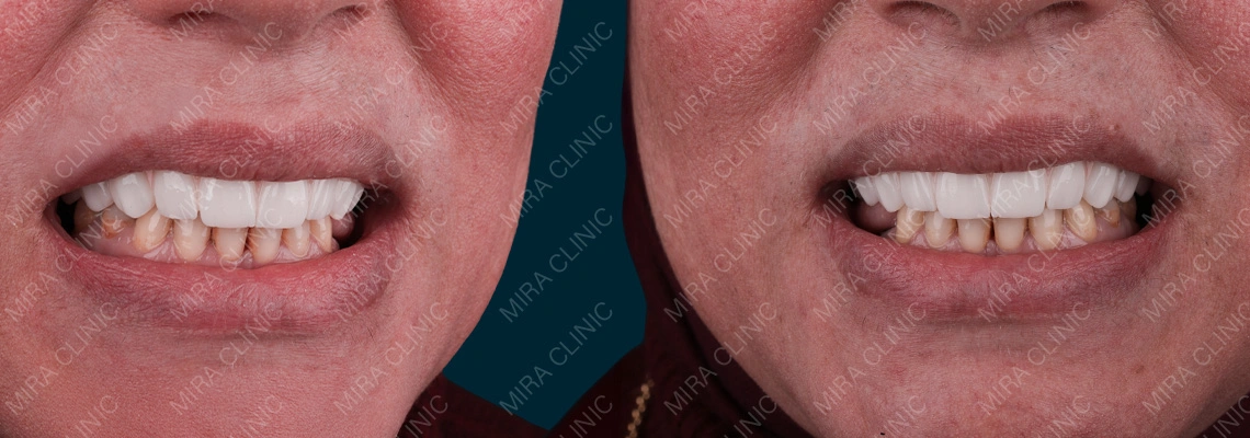 ابتسامة هوليود المصغّرة في تركيا: من 4 إلى 8 قشور وفينير بشكل استراتيجي