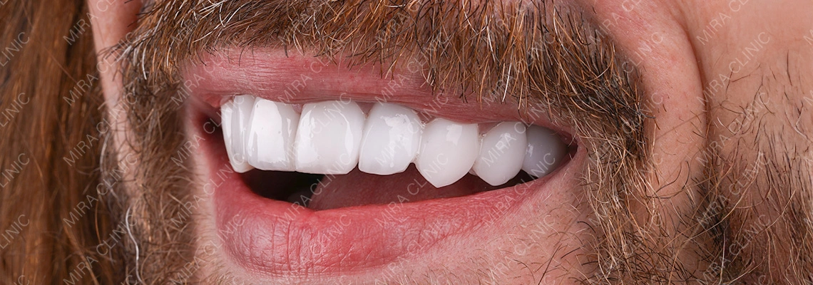 Biomimetic Dentistry in Turkey: How Mira Clinic Preserves Your Natural Enamel