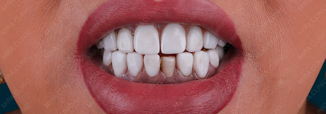 Risques du Hollywood Smile en Turquie : ce qui peut mal tourner et comment réduire les risques