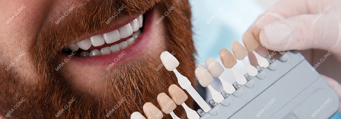 Bleach White vs. Natural Shades: How to Choose the Right Veneer Color for Your Skin Tone
