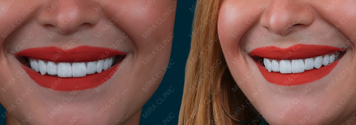 Les facettes dentaires abîment-elles les dents ? Ce qui arrive réellement à l’émail et à la préparation dentaire (Guide Turquie 2026)