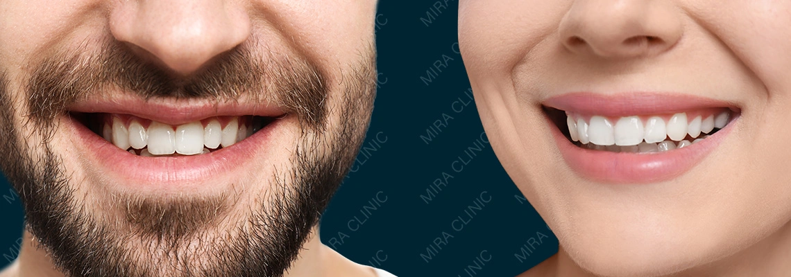 Естественная Hollywood Smile  в Турции: как избежать искусственного вида виниров